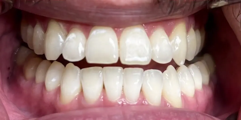 Patient's teeth after Hollywood Smile treatment, showing a bright, natural smile
