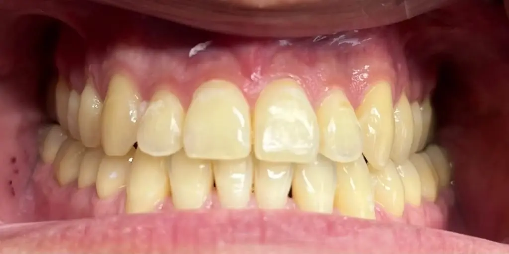 Patient's teeth before Hollywood Smile treatment at Lumora Aesthetic Dental