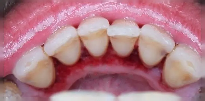 Patient's smile after dental implant treatment, with fully restored teeth