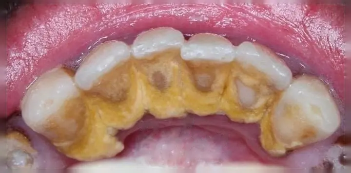 Patient's smile before dental implant treatment at Lumora Aesthetic Dental