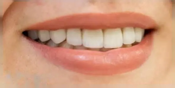 Patient's smile after oral surgery and restorative treatment