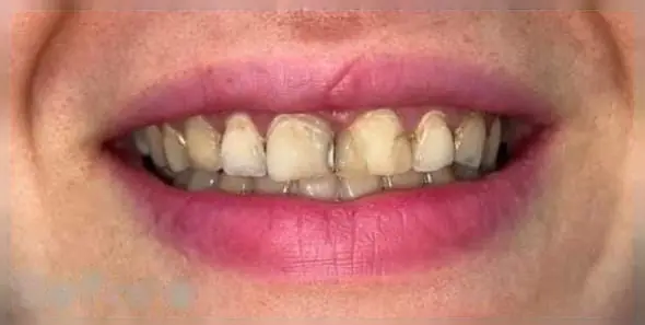 Patient's oral condition before surgical treatment at Lumora Aesthetic Dental
